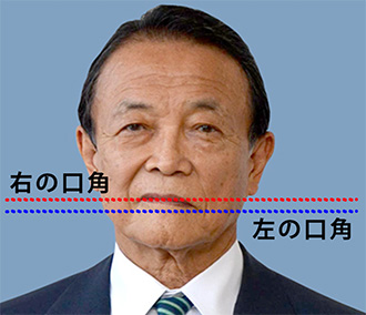 麻生太郎氏の口の歪みの左右差