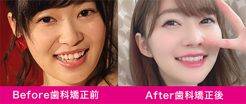 指原莉乃の歯科矯正のBefore After比較